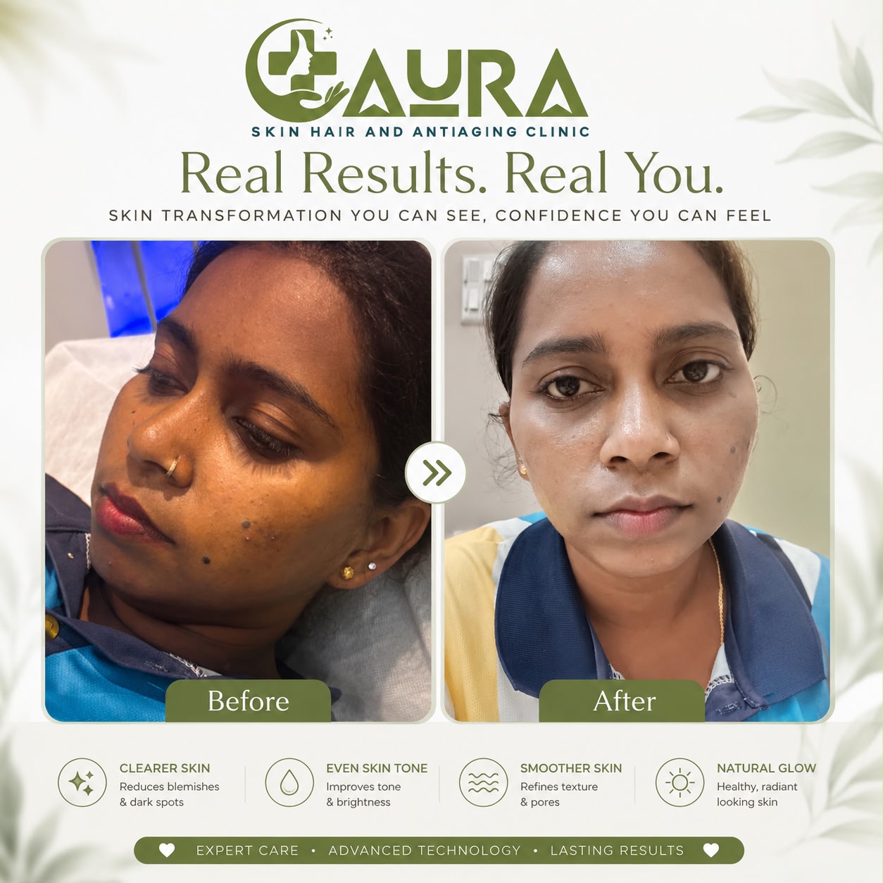 Skin transformation - Before and After treatment at Aura Clinic